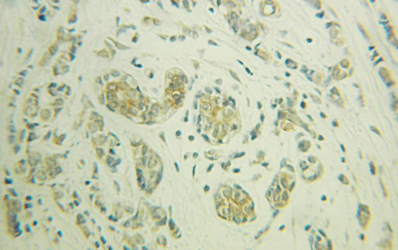 Immunohistochemical of paraffin-embedded human breast cancer using Catalog No:113278(NRG1 antibody) at dilution of 1:100 (under 25x lens)