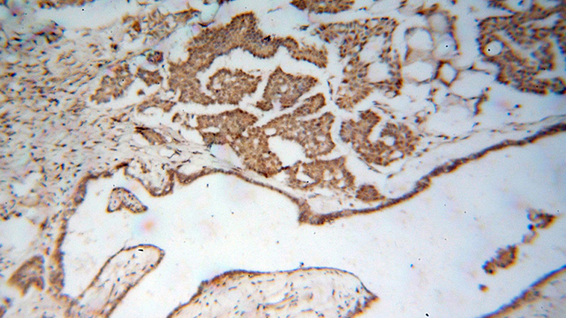 Immunohistochemical of paraffin-embedded human ovary tumor using Catalog No:109946(DIS3 antibody) at dilution of 1:100 (under 10x lens)