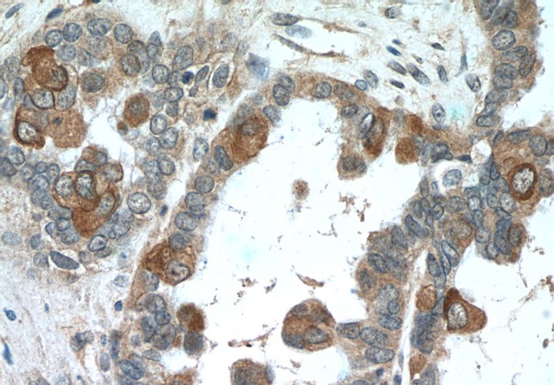 Immunohistochemistry of paraffin-embedded human ovary tumor tissue slide using Catalog No:113665(PDE6A Antibody) at dilution of 1:50 (under 40x lens)