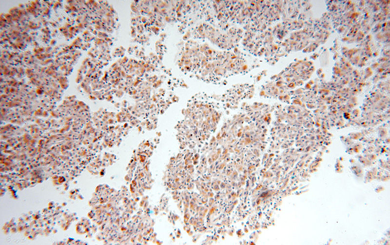 Immunohistochemical of paraffin-embedded human lung cancer using Catalog No:116993(XPNPEP3 antibody) at dilution of 1:100 (under 10x lens)