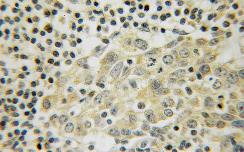 Immunohistochemical of paraffin-embedded human breast cancer using Catalog No:112139(LANCL1 antibody) at dilution of 1:50 (under 10x lens)