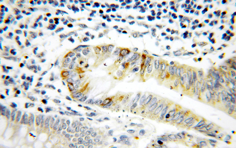 Immunohistochemical of paraffin-embedded human colon using Catalog No:112515(METT10D antibody) at dilution of 1:50 (under 40x lens)