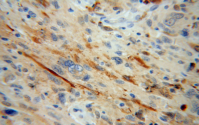 Immunohistochemical of paraffin-embedded human gliomas using Catalog No:113791(PGM2L1 antibody) at dilution of 1:50 (under 40x lens)