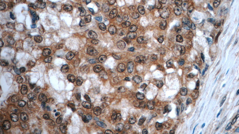 Immunohistochemistry of paraffin-embedded human prostate cancer tissue slide using Catalog No:114081(PPARG Antibody) at dilution of 1:50 (under 40x lens)