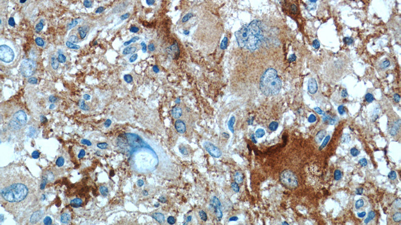 Immunohistochemistry of paraffin-embedded human gliomas tissue slide using Catalog No:108409(BAG3 Antibody) at dilution of 1:50 (under 40x lens)