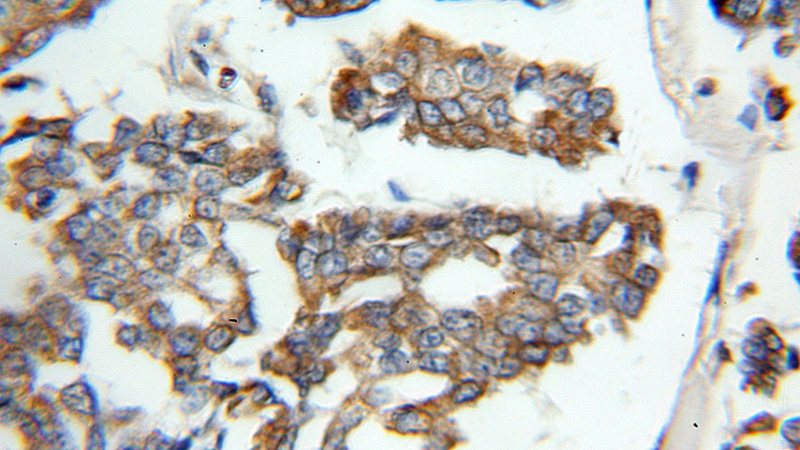 Immunohistochemical of paraffin-embedded human breast cancer using Catalog No:113039(NCKIPSD antibody) at dilution of 1:50 (under 10x lens)