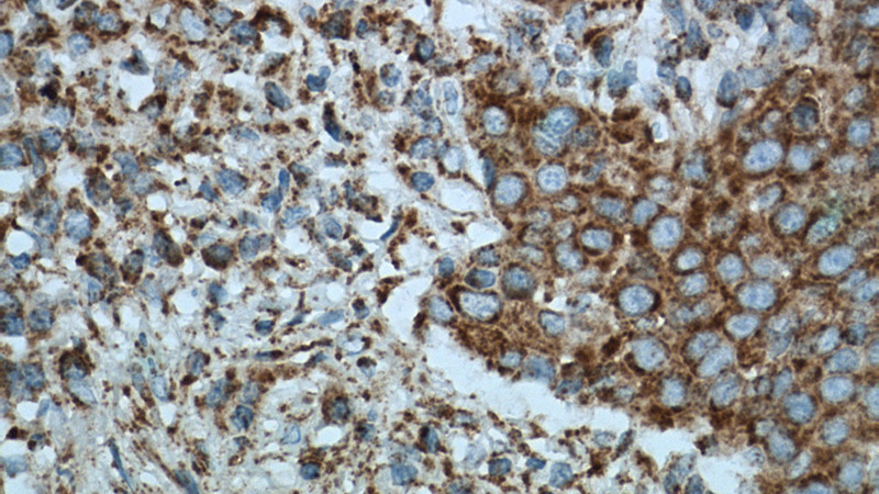 Immunohistochemistry of paraffin-embedded human lung cancer tissue slide using Catalog No:107345(OGDH Antibody) at dilution of 1:200 (under 40x lens). heat mediated antigen retrieved with Tris-EDTA buffer(pH9).