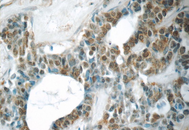 Immunohistochemistry of paraffin-embedded human cervical cancer tissue slide using Catalog No:116883(YEATS2 Antibody) at dilution of 1:50 (under 40x lens)