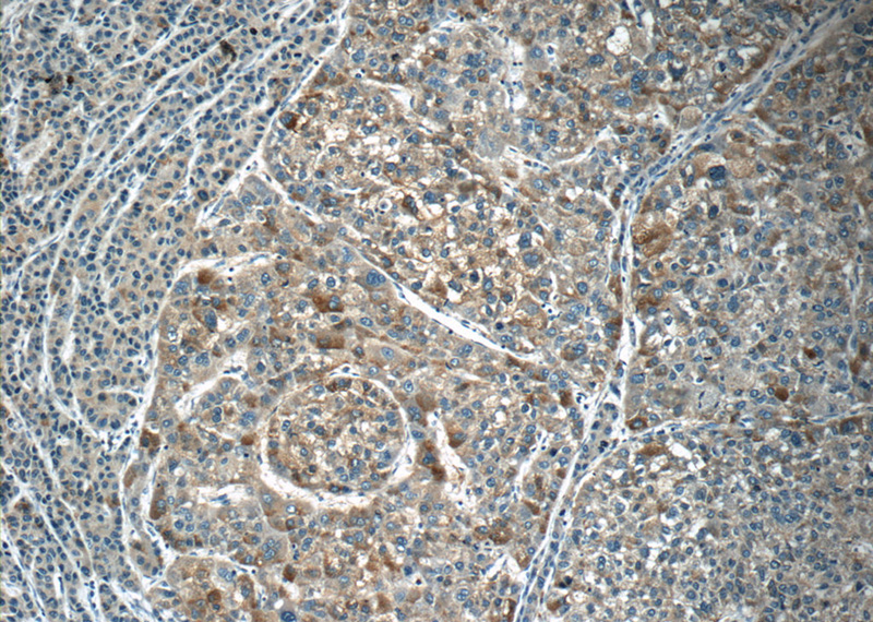 Immunohistochemistry of paraffin-embedded human liver cancer tissue slide using Catalog No:108052(ANGPT2 Antibody) at dilution of 1:50 (under 10x lens)