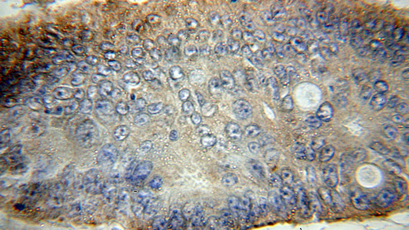 Immunohistochemical of paraffin-embedded human colon cancer using Catalog No:115793(STX16 antibody) at dilution of 1:50 (under 10x lens)