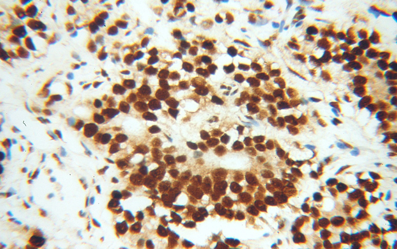 Immunohistochemical of paraffin-embedded human gliomas using Catalog No:115925(TARDBP antibody) at dilution of 1:200 (under 40x lens)