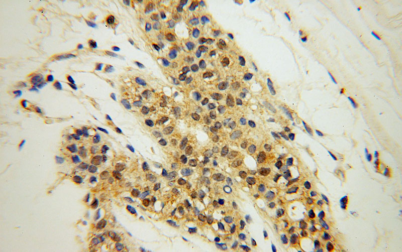 Immunohistochemical of paraffin-embedded human colon cancer using Catalog No:115535(SPAG7 antibody) at dilution of 1:50 (under 40x lens)