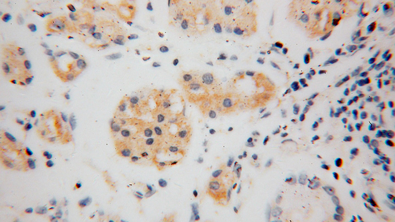 Immunohistochemical of paraffin-embedded human stomach cancer using Catalog No:116058(THTPA antibody) at dilution of 1:50 (under 40x lens)