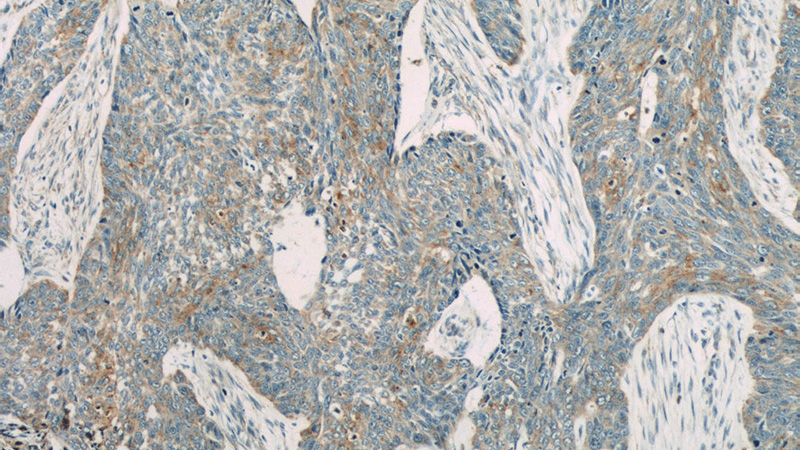 Immunohistochemistry of paraffin-embedded human skin cancer slide using Catalog No:111159(PCDGF,GRN Antibody) at dilution of 1:50