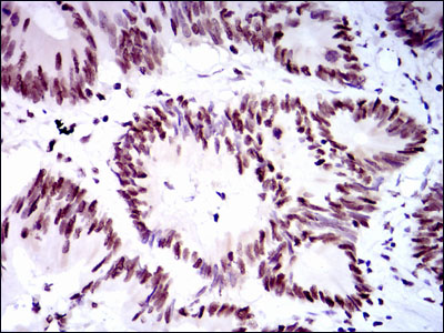 Immunohistochemical analysis of paraffin-embedded colon cancer tissues using RPA1 mouse mAb with DAB staining.
