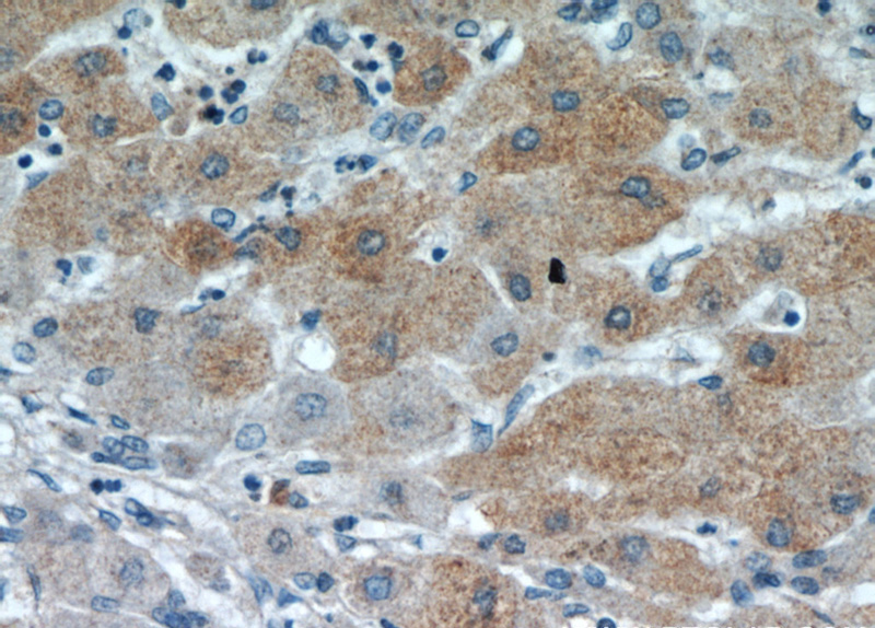 Immunohistochemical of paraffin-embedded human hepatocirrhosis using Catalog No:113641(PDXDC1 antibody) at dilution of 1:100 (under 40x lens)