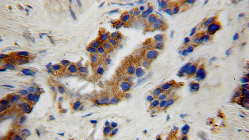 Immunohistochemical of paraffin-embedded human gliomas using Catalog No:108742(CA10 antibody) at dilution of 1:100 (under 10x lens)