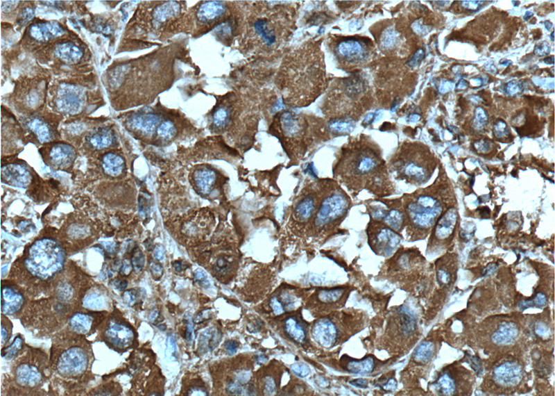Immunohistochemistry of paraffin-embedded human liver cancer tissue slide using Catalog No:107242(DSE Antibody) at dilution of 1:200 (under 40x lens). heat mediated antigen retrieved with Tris-EDTA buffer(pH9).