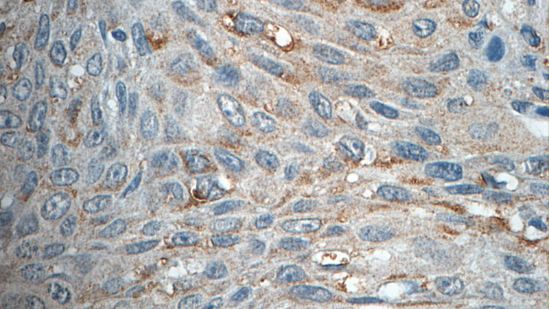 Immunohistochemistry of paraffin-embedded human lung cancer tissue slide using Catalog No:107916(AGBL3 Antibody) at dilution of 1:50 (under 40x lens)