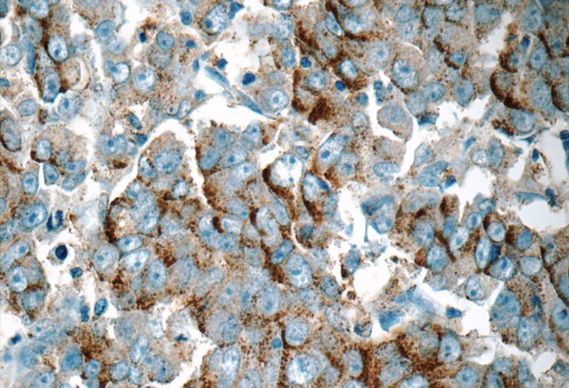 Immunohistochemistry of paraffin-embedded human prostate cancer tissue slide using Catalog No:114444(RAB3D Antibody) at dilution of 1:50 (under 40x lens)