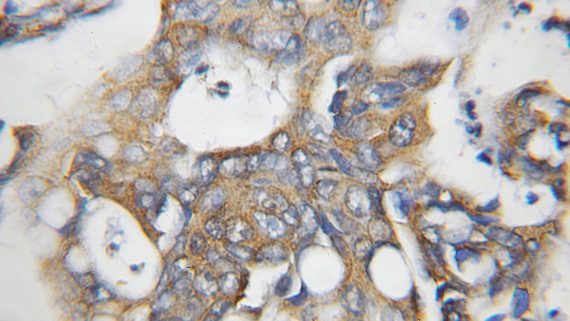 Immunohistochemical of paraffin-embedded human colon cancer using Catalog No:113032(NCAPH antibody) at dilution of 1:50 (under 10x lens)