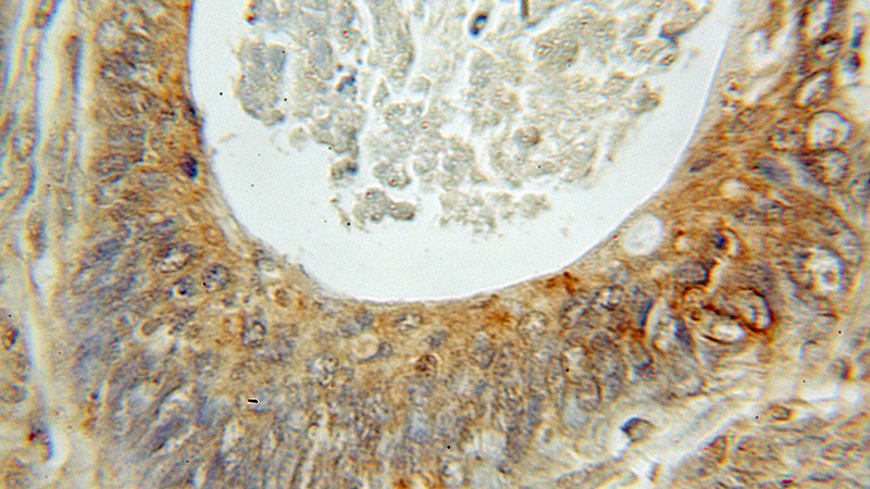 Immunohistochemical of paraffin-embedded human ovary tumor using Catalog No:110648(Fhl1 antibody) at dilution of 1:50 (under 10x lens)