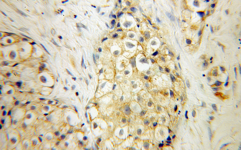 Immunohistochemical of paraffin-embedded human lung cancer using Catalog No:115239(SIRPB1 antibody) at dilution of 1:50 (under 40x lens)