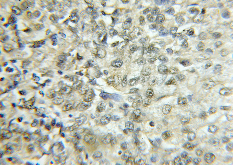 Immunohistochemical of paraffin-embedded human lung cancer using Catalog No:110224(EHD2 antibody) at dilution of 1:50 (under 10x lens)
