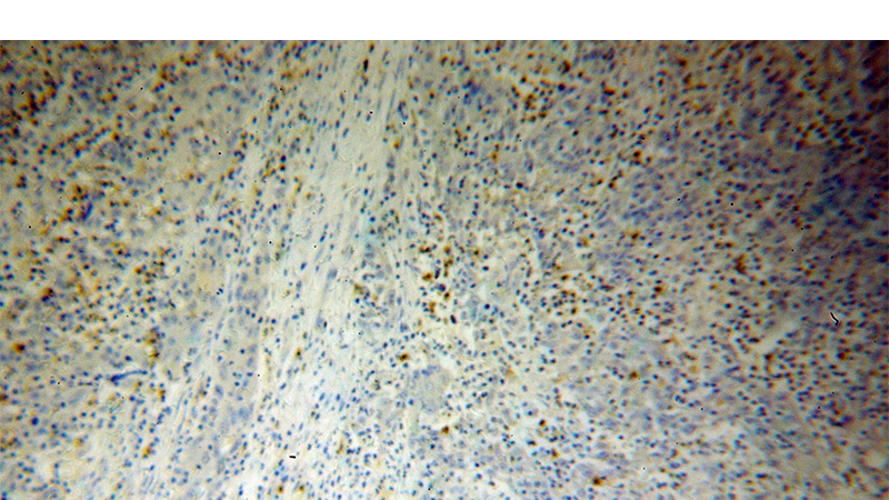 Immunohistochemical of paraffin-embedded human colon cancer using Catalog No:110645(FGL2 antibody) at dilution of 1:50 (under 10x lens)