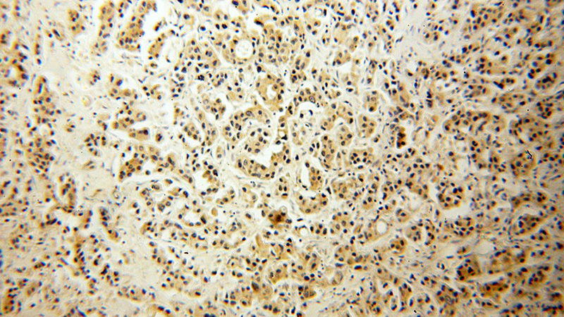 Immunohistochemical of paraffin-embedded human breast cancer using Catalog No:108866(CSNK1E antibody) at dilution of 1:50 (under 10x lens)