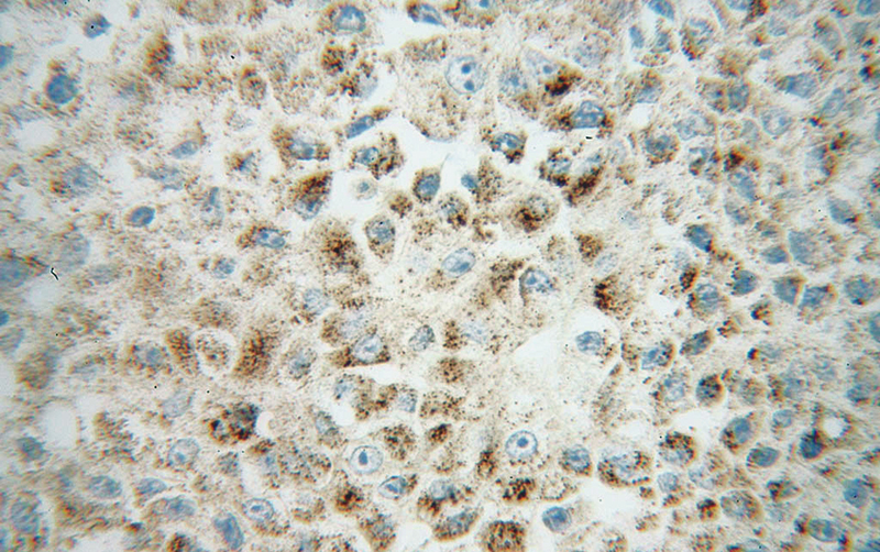Immunohistochemical of paraffin-embedded human liver cancer using Catalog No:107749(AOX antibody) at dilution of 1:100 (under 40x lens)