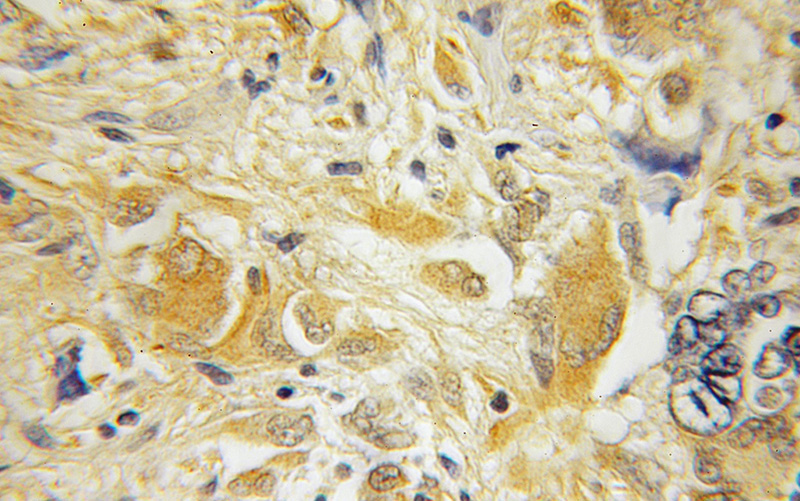 Immunohistochemical of paraffin-embedded human medulloblastoma using Catalog No:111445(HPCAL4 antibody) at dilution of 1:100 (under 10x lens)