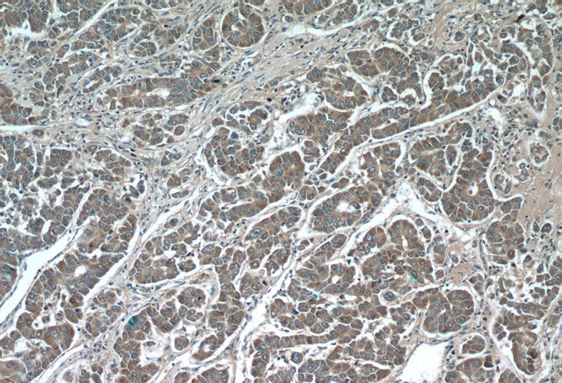 Immunohistochemistry of paraffin-embedded human liver cancer tissue slide using Catalog No:111825(IQGAP2 Antibody) at dilution of 1:50 (under 10x lens)