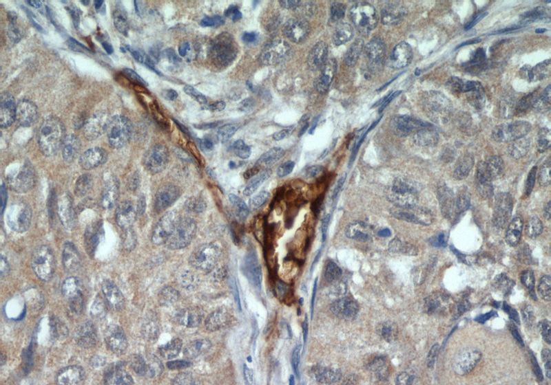 Immunohistochemical of paraffin-embedded human lung cancer using Catalog No:115942(CD248 antibody) at dilution of 1:100 (under 40x lens)