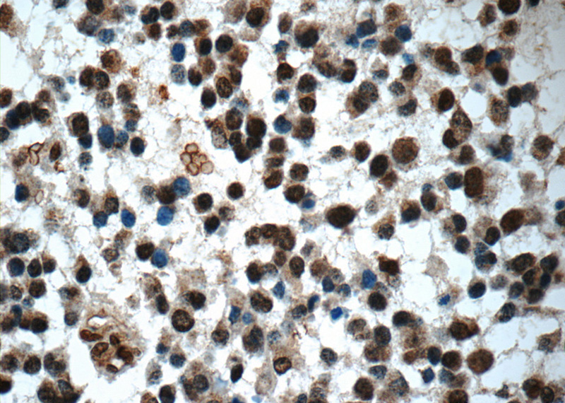 Immunohistochemistry of paraffin-embedded human gliomas tissue slide using Catalog No:116946(ZNF124 Antibody) at dilution of 1:50 (under 40x lens)
