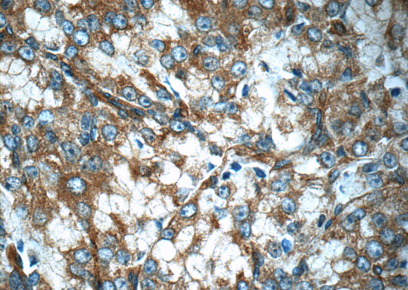 Immunohistochemistry of paraffin-embedded human prostate cancer slide using Catalog No:117195(BMP15 Antibody) at dilution of 1:50 (under 40x lens)