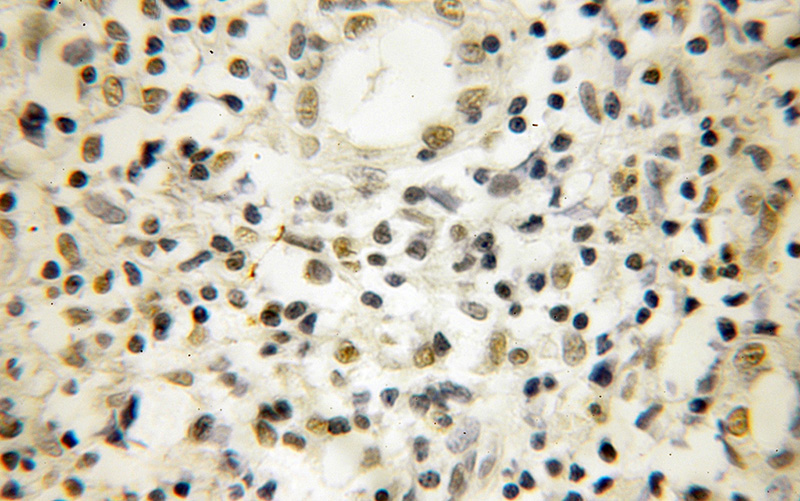 Immunohistochemical of paraffin-embedded human lymphoma using Catalog No:113262(NOB1 antibody) at dilution of 1:25 (under 10x lens)
