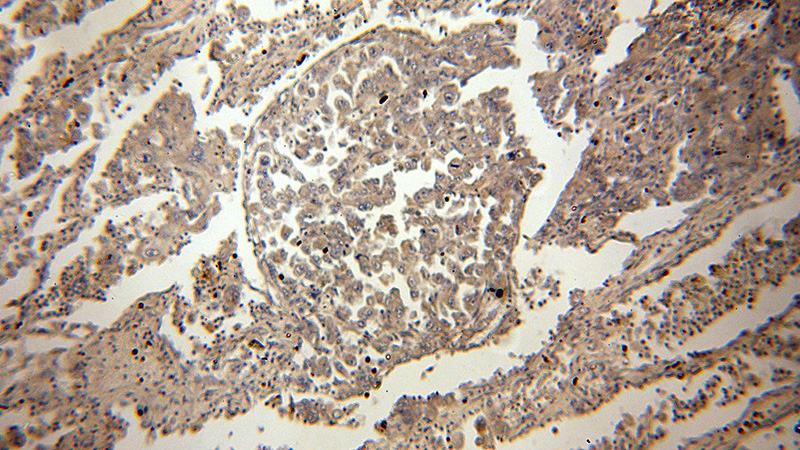 Immunohistochemical of paraffin-embedded human lung cancer using Catalog No:110447(FADD antibody) at dilution of 1:50 (under 10x lens)