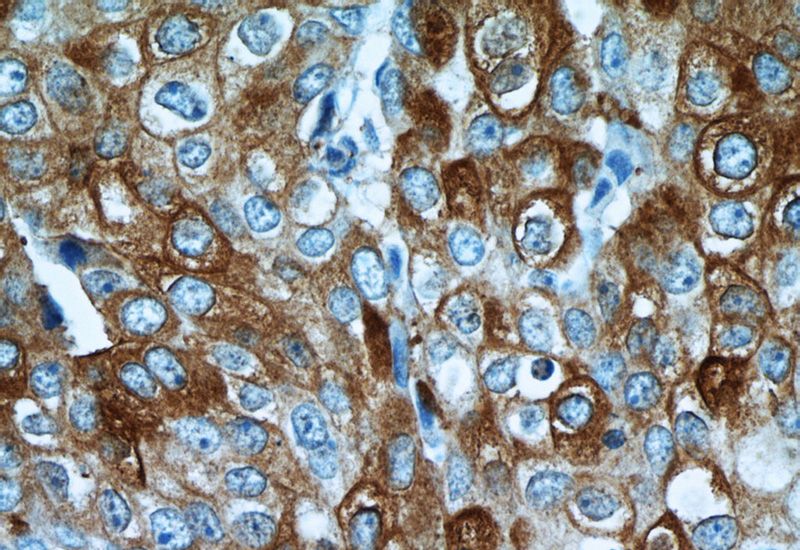 Immunohistochemistry of paraffin-embedded human breast cancer tissue slide using Catalog No:114787(ROR1 Antibody) at dilution of 1:50 (under 40x lens)