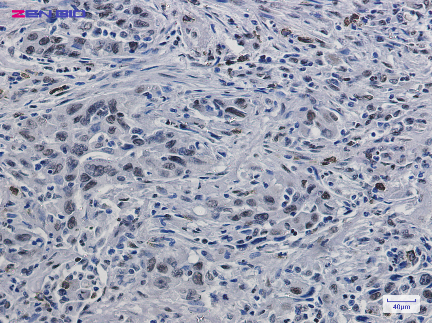 Immunohistochemistry of Histone H3.3 in paraffin-embedded Human lung cancer tissue using Histone H3.3 Rabbit pAb at dilution 1/50