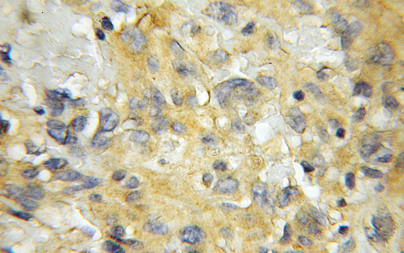 Immunohistochemical of paraffin-embedded human gliomas using Catalog No:115020(SCRN2 antibody) at dilution of 1:50 (under 40x lens)