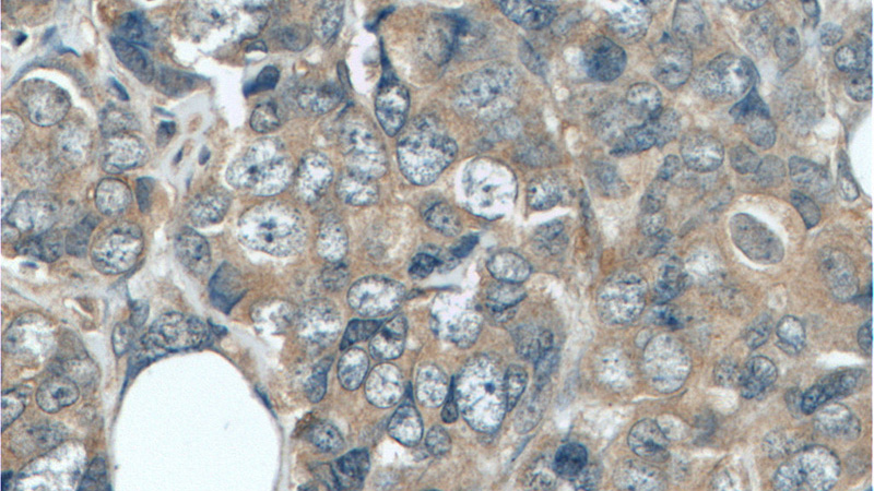 Immunohistochemistry of paraffin-embedded human breast cancer tissue slide using Catalog No:110970(GIGYF2 Antibody) at dilution of 1:50 (under 40x lens)