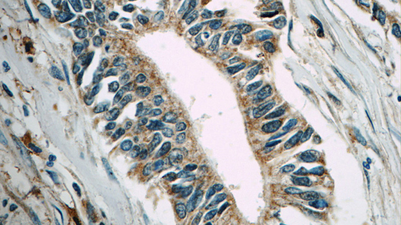 Immunohistochemistry of paraffin-embedded human pancreas cancer tissue slide using Catalog No:112678(MAP3K10 Antibody) at dilution of 1:50 (under 40x lens)