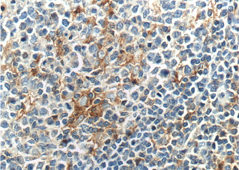 Immunohistochemistry of paraffin-embedded human tonsillitis tissue slide using Catalog No:109062(CD18 Antibody) at dilution of 1:200 (under 40x lens). heat mediated antigen retrieved with Tris-EDTA buffer(pH9).