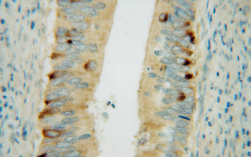 Immunohistochemical of paraffin-embedded human colon cancer using Catalog No:108940(CBR3 antibody) at dilution of 1:50 (under 40x lens)