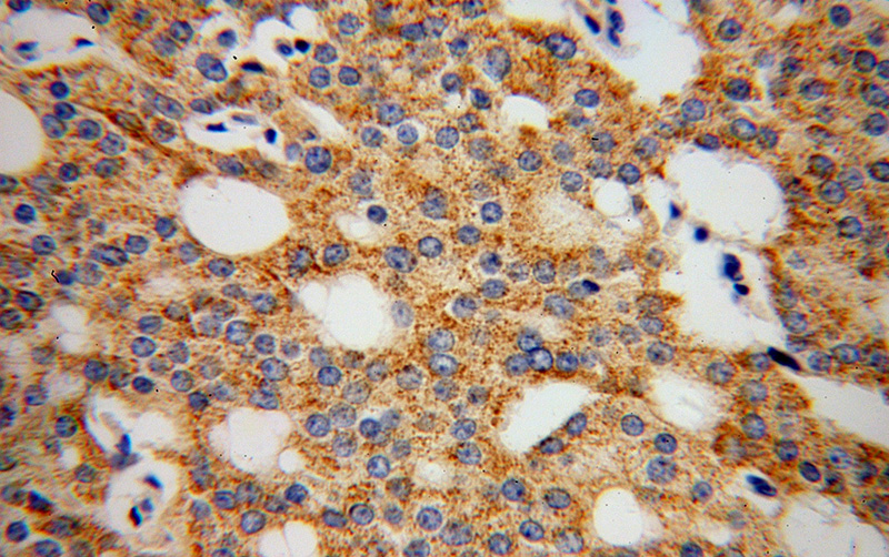 Immunohistochemical of paraffin-embedded human prostate cancer using Catalog No:114415(RAB18 antibody) at dilution of 1:100 (under 40x lens)