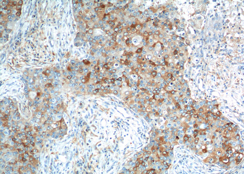 Immunohistochemistry of paraffin-embedded human breast cancer tissue slide using Catalog No:111661(IL13RA2,CD213A2 Antibody) at dilution of 1:200 (under 10x lens).