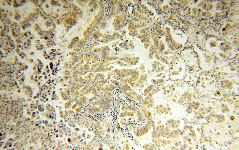 Immunohistochemical of paraffin-embedded human lung cancer using Catalog No:108842(CAPSL antibody) at dilution of 1:100 (under 10x lens)