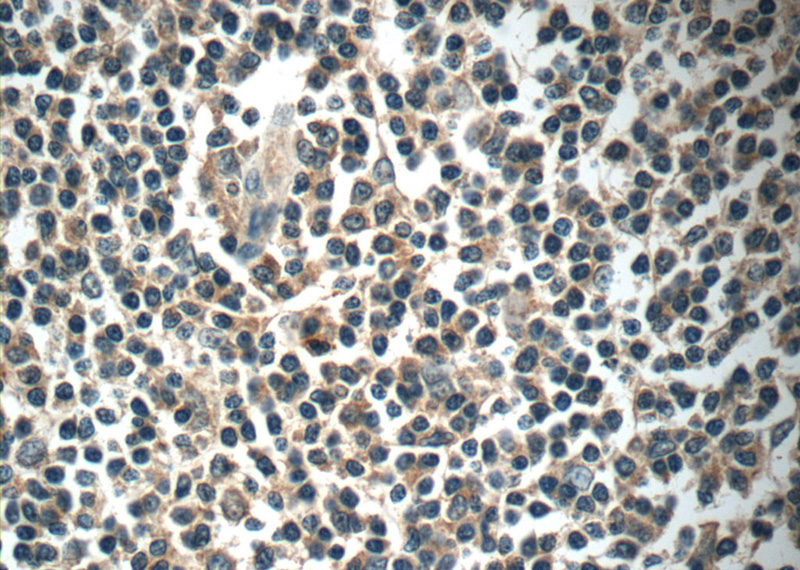 Immunohistochemistry of paraffin-embedded human tonsillitis tissue slide using Catalog No:112975(MYLK4 Antibody) at dilution of 1:50 (under 40x lens)