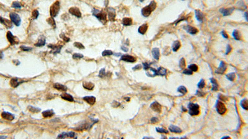 Immunohistochemical of paraffin-embedded human prostate cancer using Catalog No:115436(SMARCE1 antibody) at dilution of 1:100 (under 40x lens)